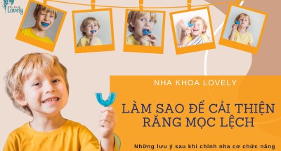 Làm sao cải thiện vấn đề răng mọc lệch của trẻ em - Những lưu ý sau khi chỉnh nha cơ chức năng