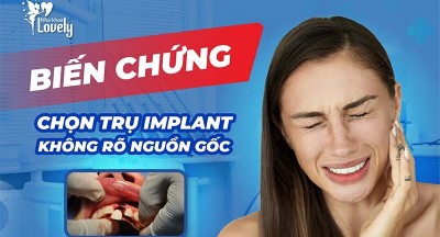 Những biến chứng khi chọn trụ Implant không rõ nguồn gốc