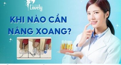 KHI NÀO CẦN NÂNG XOANG