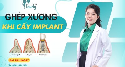 TRƯỜNG HỢP NÀO CẦN GHÉP XƯƠNG KHI CẤY GHÉP IMPLANT?