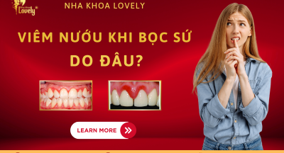 Viêm nướu khi bọc sứ do đâu?