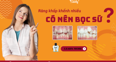 RĂNG KHẤP KHỂNH NHIỀU CÓ NÊN BỌC SỨ?