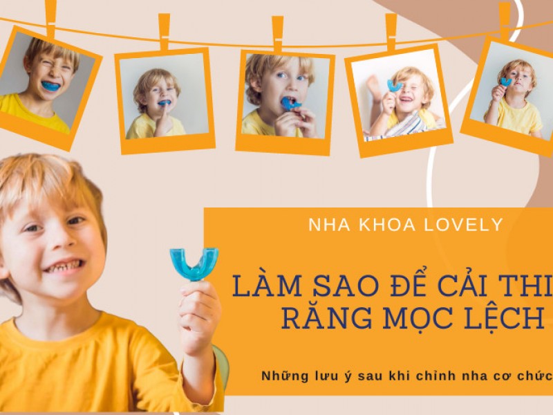 Làm sao cải thiện vấn đề răng mọc lệch của trẻ em - Những lưu ý sau khi chỉnh nha cơ chức năng