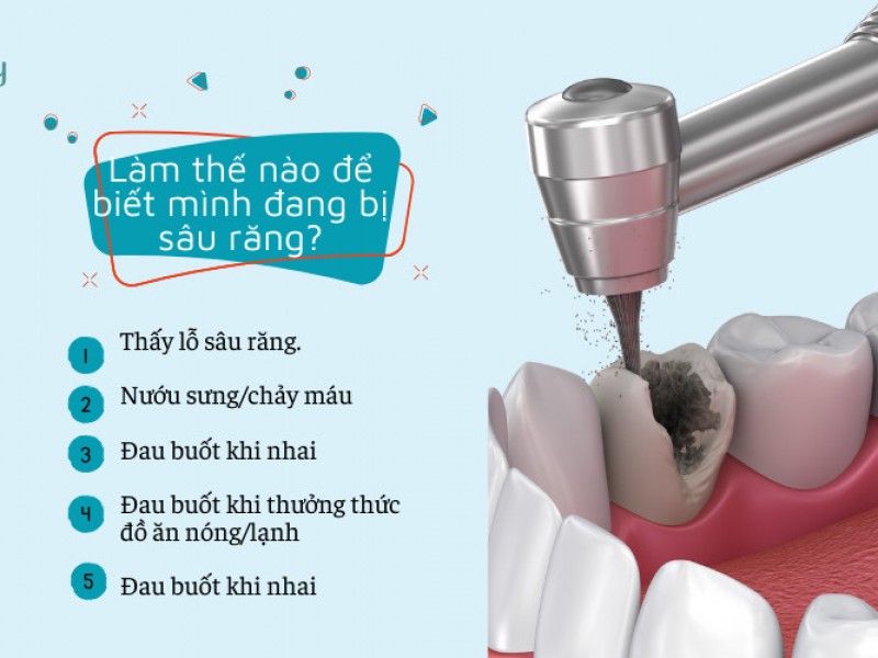 Các dấu hiệu nhận biết sâu răng