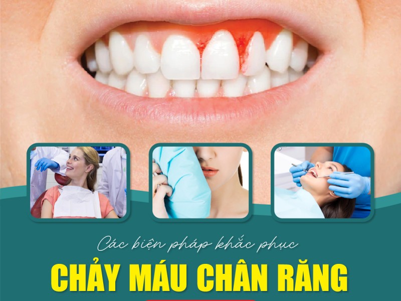 Các biện pháp khắc phục tình trạng chảy máu chân răng