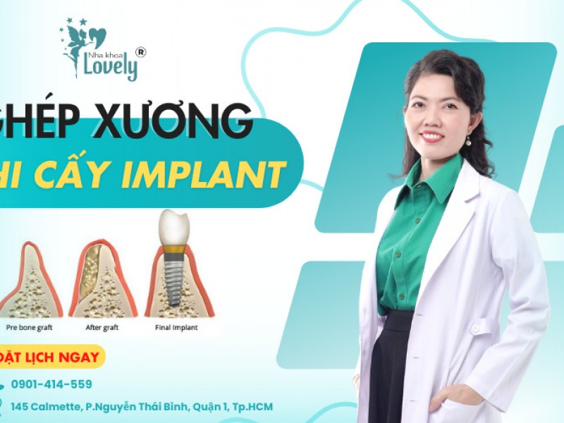 TRƯỜNG HỢP NÀO CẦN GHÉP XƯƠNG KHI CẤY GHÉP IMPLANT?