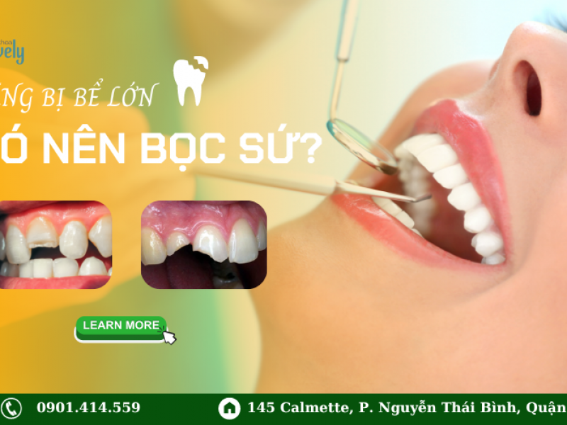 RĂNG BỊ BỂ LỚN CÓ NÊN BỌC SỨ?